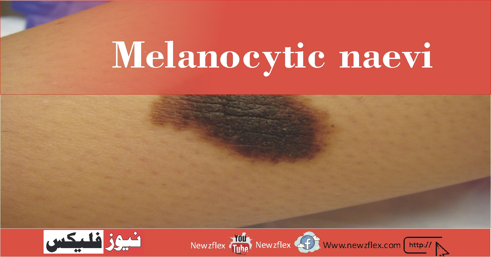 Melanocytic naevi